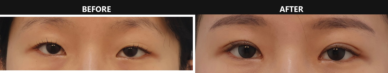 Before-and-after photo of a Korean female patient one month after combined incision double eyelid surgery, ptosis correction, and epicanthoplasty at Link Plastic Surgery