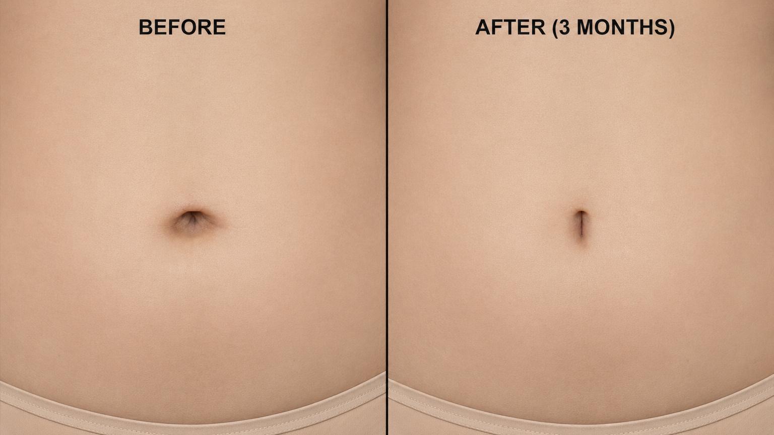 Before-and-after of an East Asian woman three months after Korean umbilicoplasty showing a wide hooded belly button refined to a narrow vertical slit shape