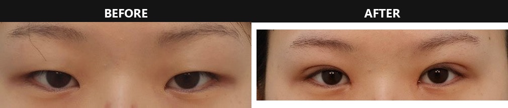 Before-and-after photo showing combined incision blepharoplasty with eyelid fat removal, epicanthoplasty, and ptosis correction at one month post-op