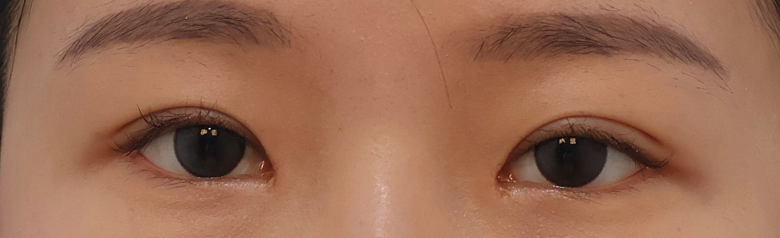 Close-up of a Korean patient's eyes one month after incision double eyelid surgery showing a balanced and natural crease line