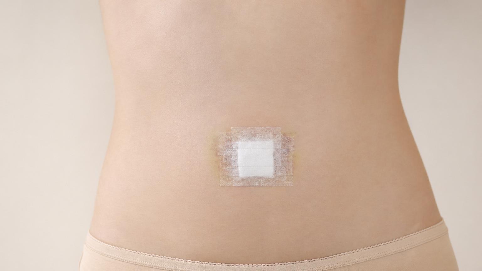 Day 5 post-op after Korean umbilicoplasty — small surgical dressing and medical tape over the navel with mild fading bruising