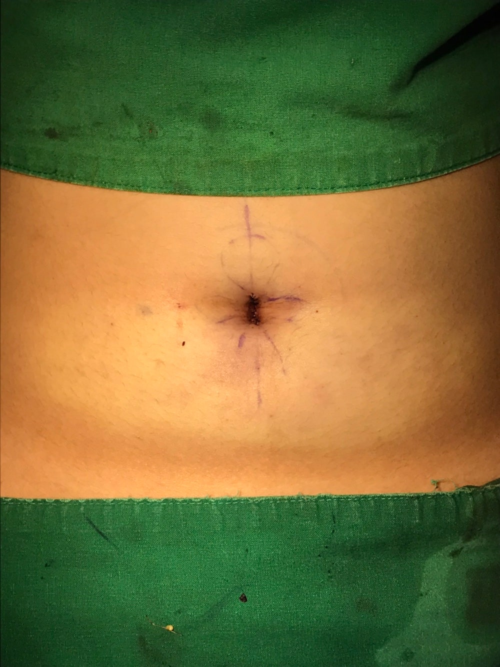 Belly button before umbilicoplasty - stretched navel from pregnancy