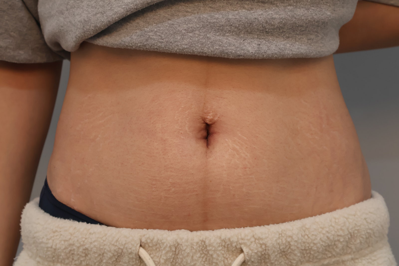 Belly button result 31 days after umbilicoplasty