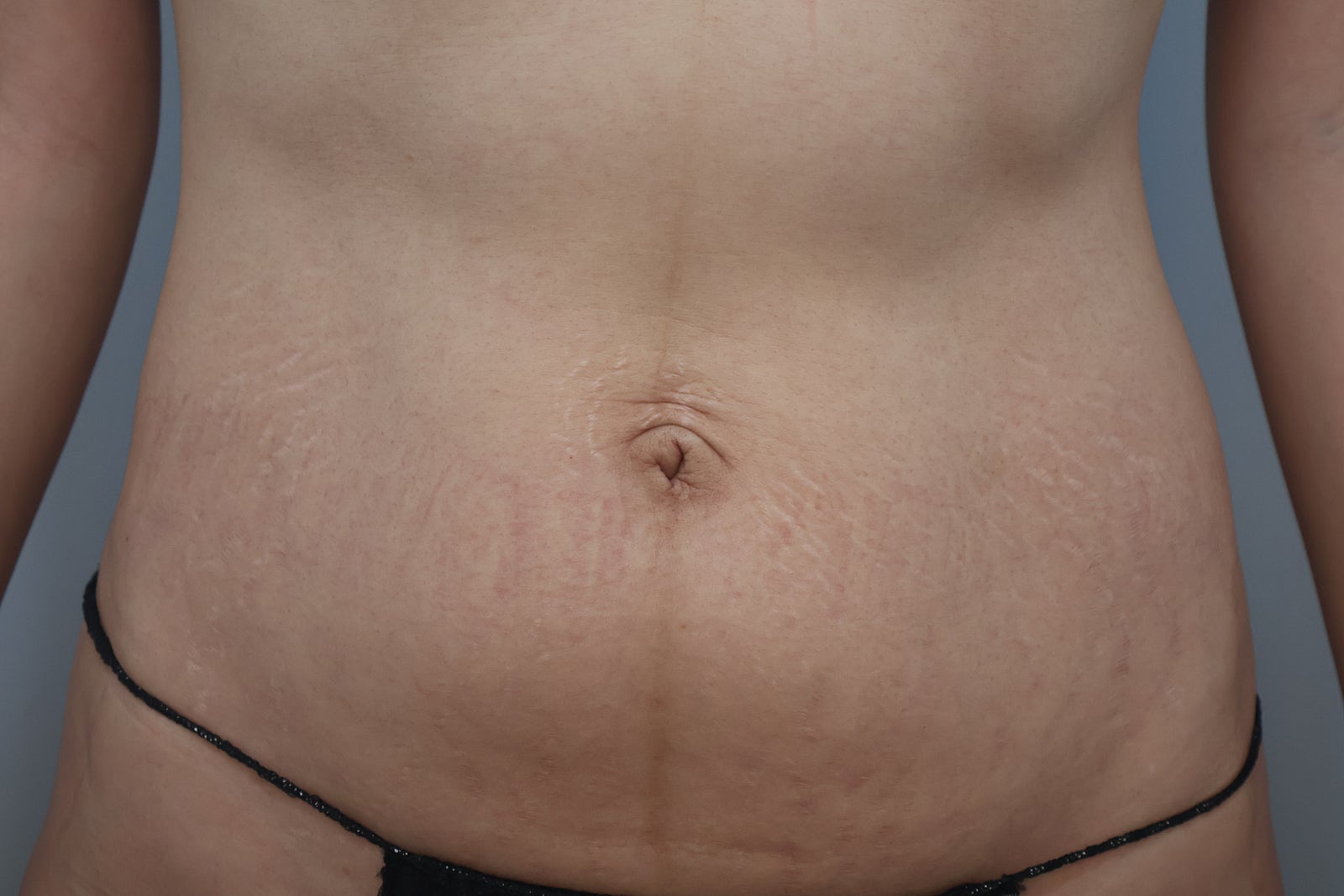 Protruding belly button before umbilicoplasty surgery