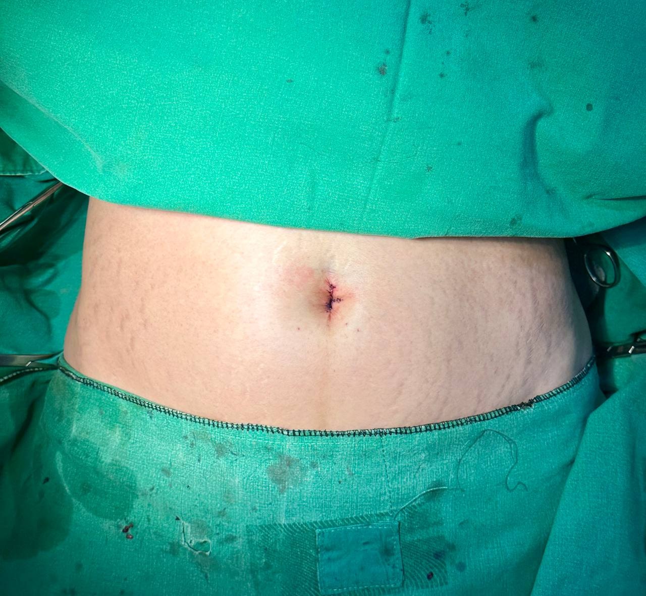 Belly button after reshaping - vertical oval navel result