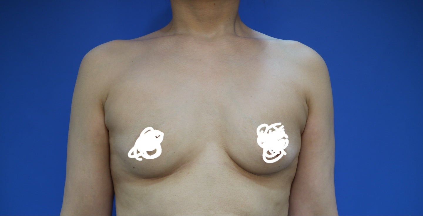 Breast augmentation revision surgery result