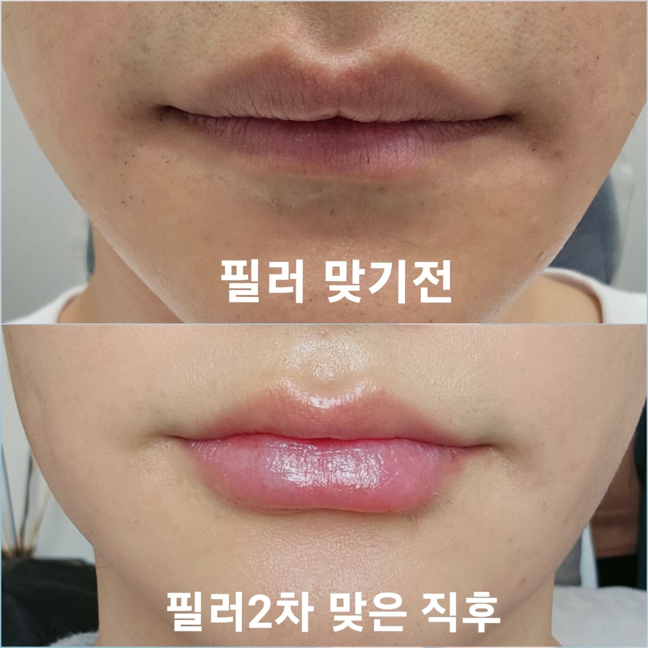 Thin lips before lip filler injection in Korea