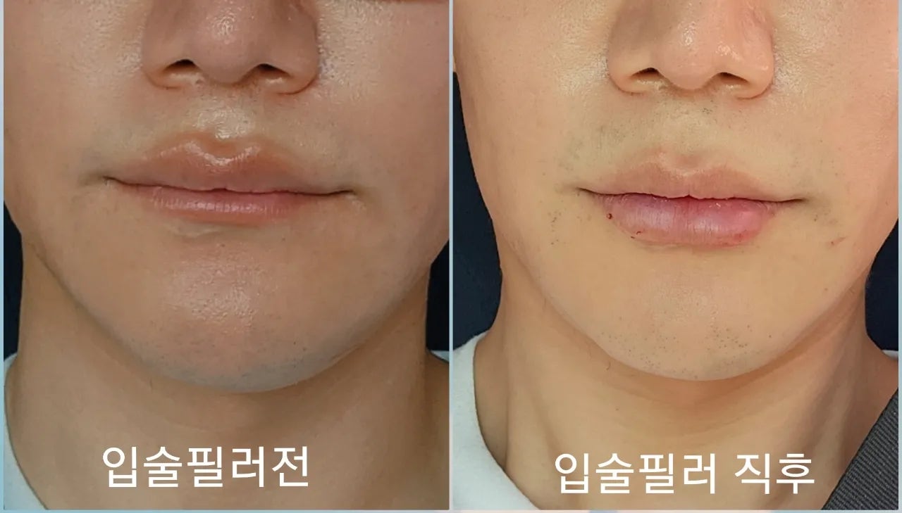Natural lip filler result from Korean injector - even volume distribution