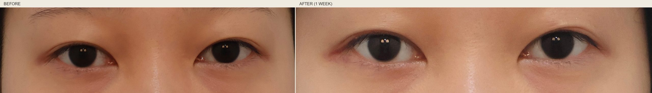 Real Link Plastic Surgery patient — standalone upper eyelid fat removal, before and one-week post-op, anonymized eye-region close-up showing thinner upper-lid platform without changing eye crease