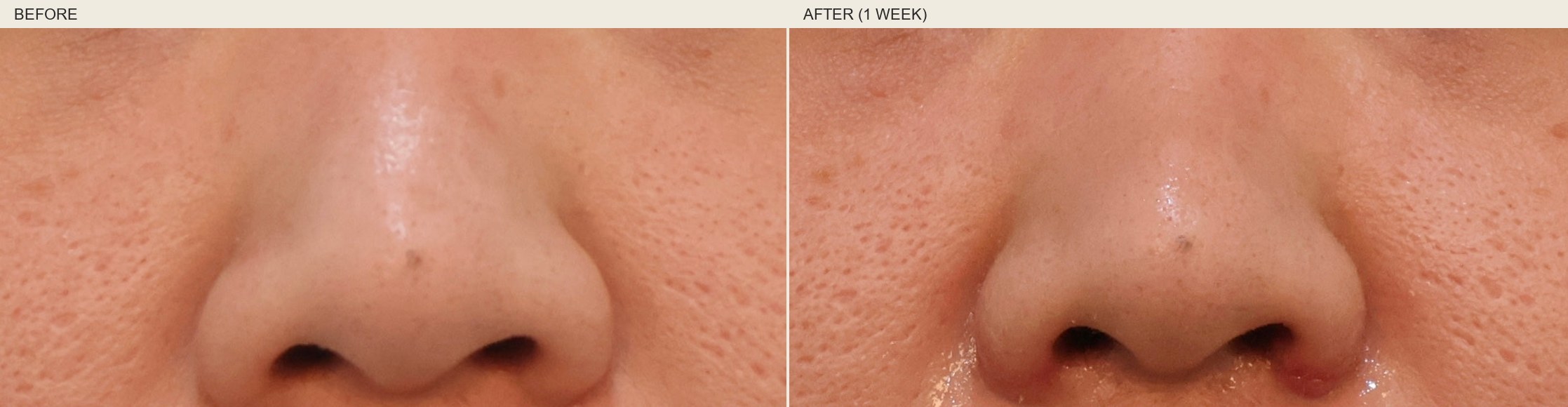Real Link Plastic Surgery patient — internal/external combined alar reduction, before and one-week post-op, anonymized front-view close-up showing visible narrowing without changing the bridge or tip