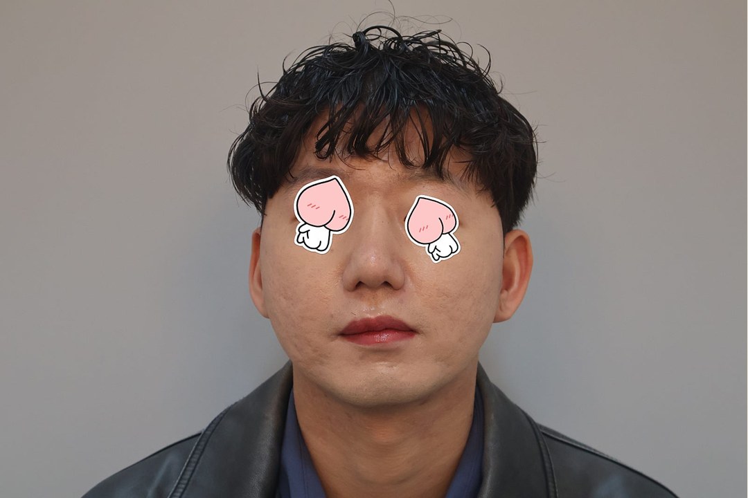 Real Link Plastic Surgery patient at day 37 post-rhinoplasty (anonymized close-up, eye region covered for privacy) showing natural refined bridge and tip