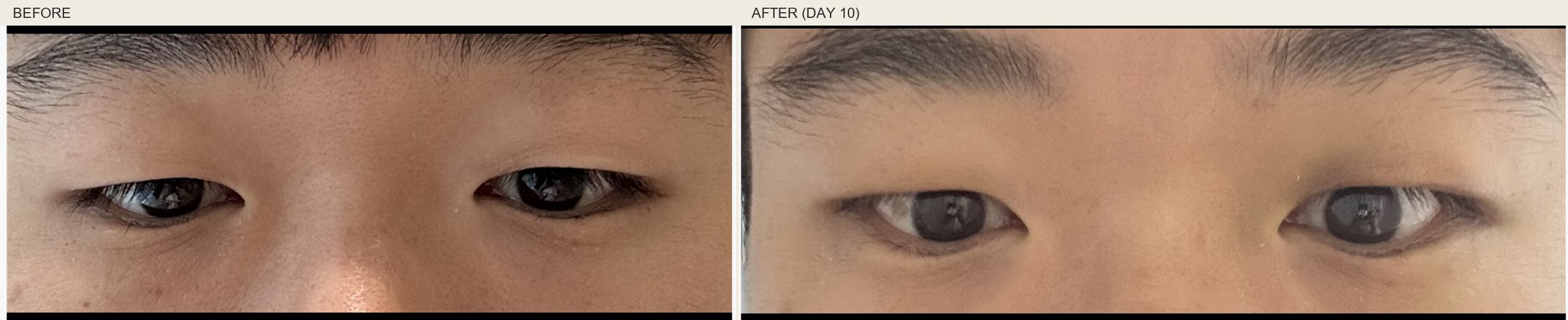Another Link Plastic Surgery patient at day-10 post-op (anonymized eye-region close-up) showing the natural lighter upper-lid contour with minor residual color change near the lid margin