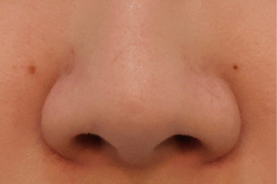 Front-view BEFORE photo from a Link Plastic Surgery patient consultation showing mild-to-moderate alar flare, the most common indication for standalone alar reduction (anonymized close-up)