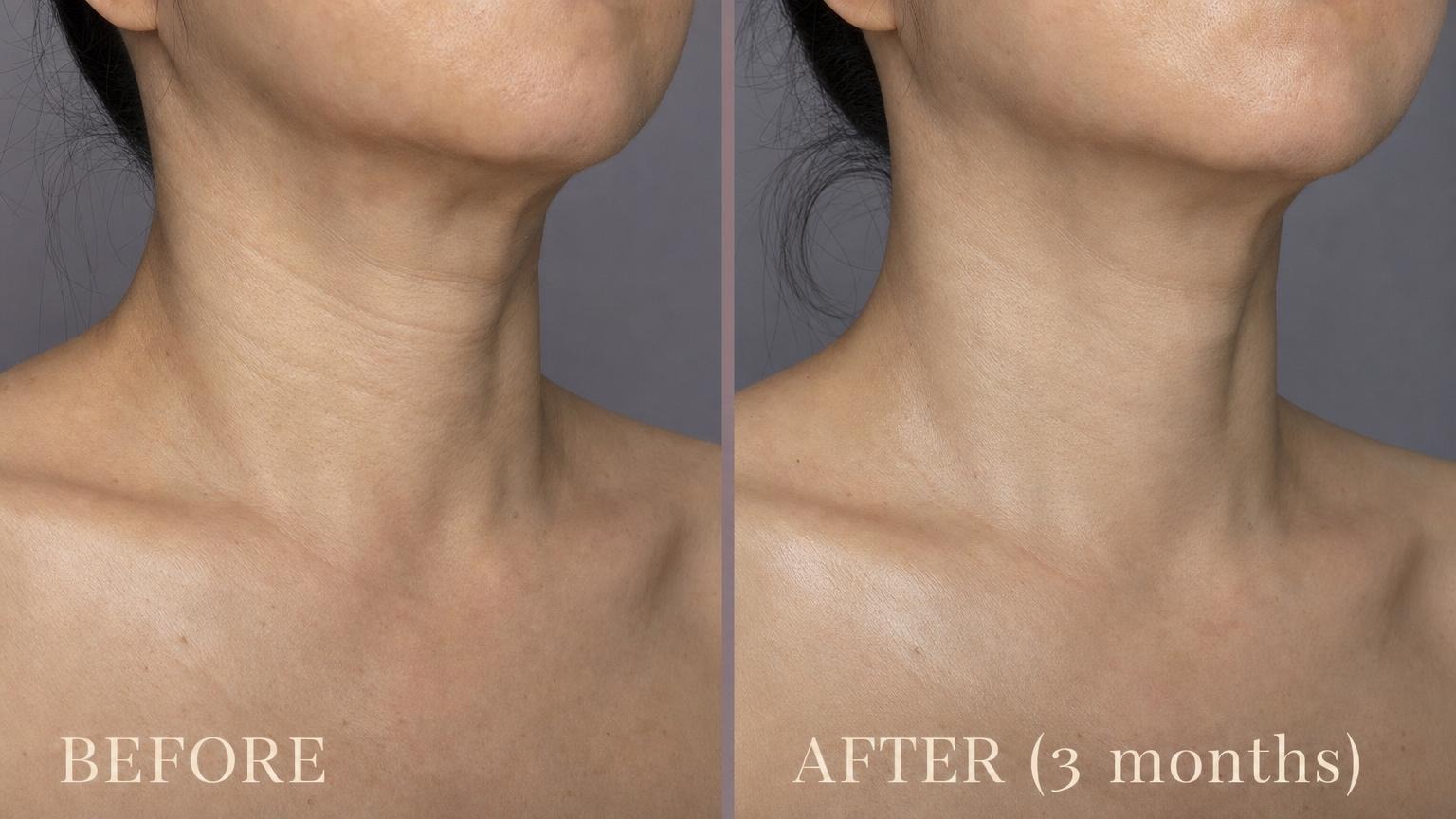 Korean neck treatment before and after close-up