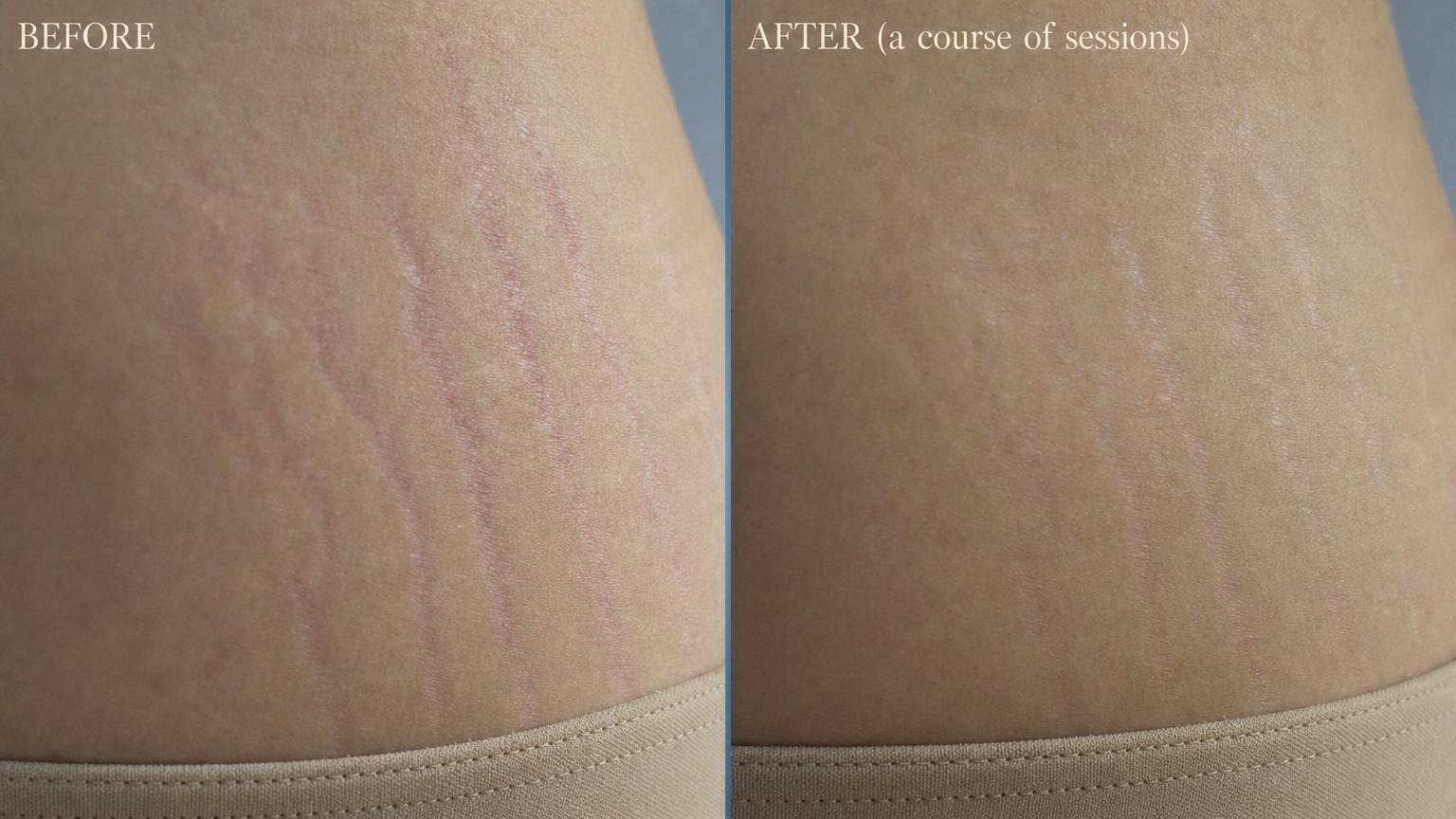 Korean stretch mark before and after skin close-up