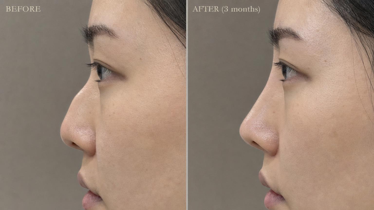 Functional rhinoplasty before and after nose profile close-up