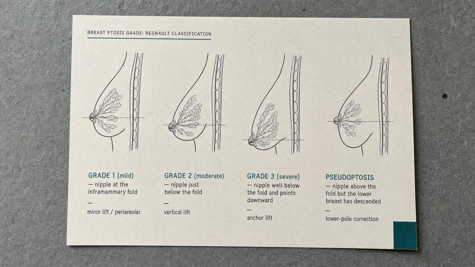 Breast ptosis grade Regnault classification diagram showing grade 1 mild, grade 2 moderate, grade 3 severe, and pseudoptosis
