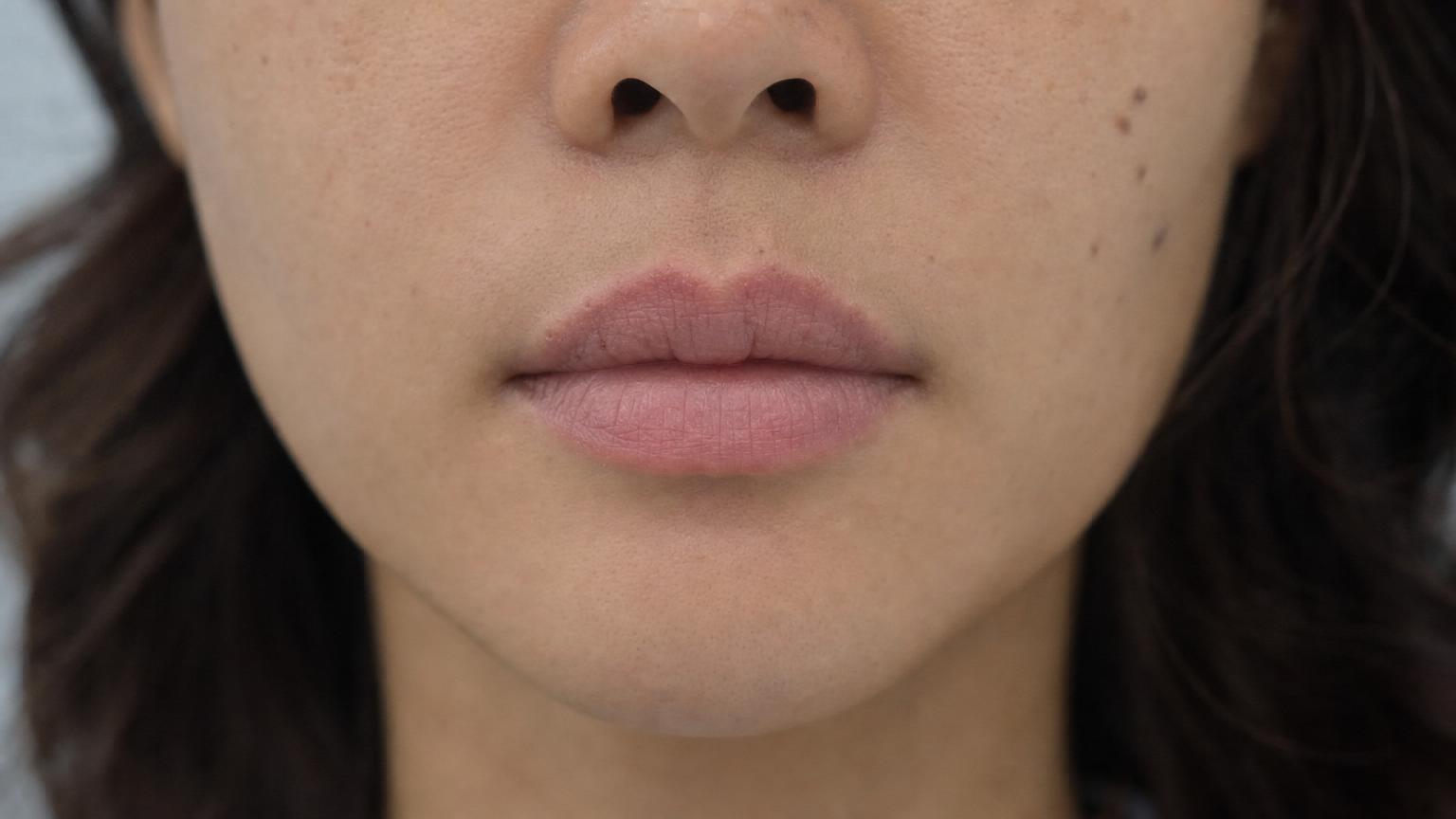 Macro close-up portrait of a Singaporean Chinese woman in her early 30s 30 minutes after Restylane Kysse lip filler injection at a Seoul clinic showing 4 to 6 tiny pinpoint entry marks faintly visible along the vermilion border with subtle pink halo at two entry points only, very faint diffuse swelling without overdone pillow-look, cool blue-gray clinic lighting and pale gray-blue background, Korean natural design markers with 1:1.3 ratio and intact philtrum column