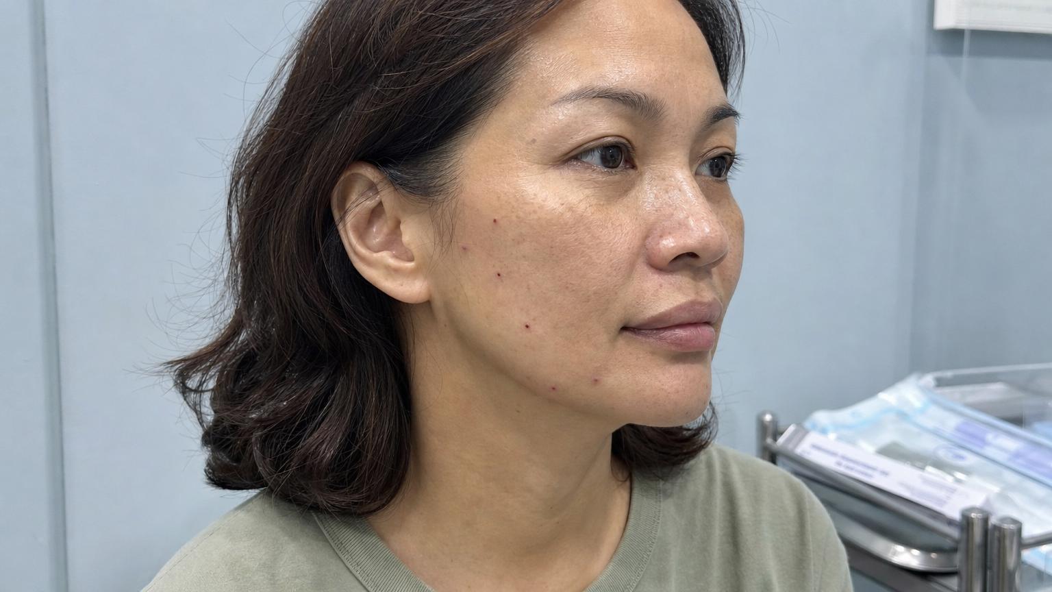Different patient case (Japanese woman in her early forties) 48 hours after a Flower Lift Flutter 6-strand session showing small healed entry points behind the temporal hairline and mild swelling along the lateral cheek vector in a soft pink and warm gray Korean clinic recovery setting