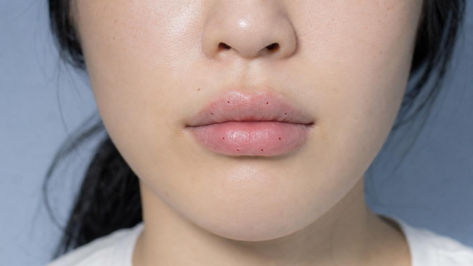 Lip Rejuran 24 hours after injection session: 6-8 small injection point marks visible, minimal swelling, no bruising in well-executed Korean protocol.