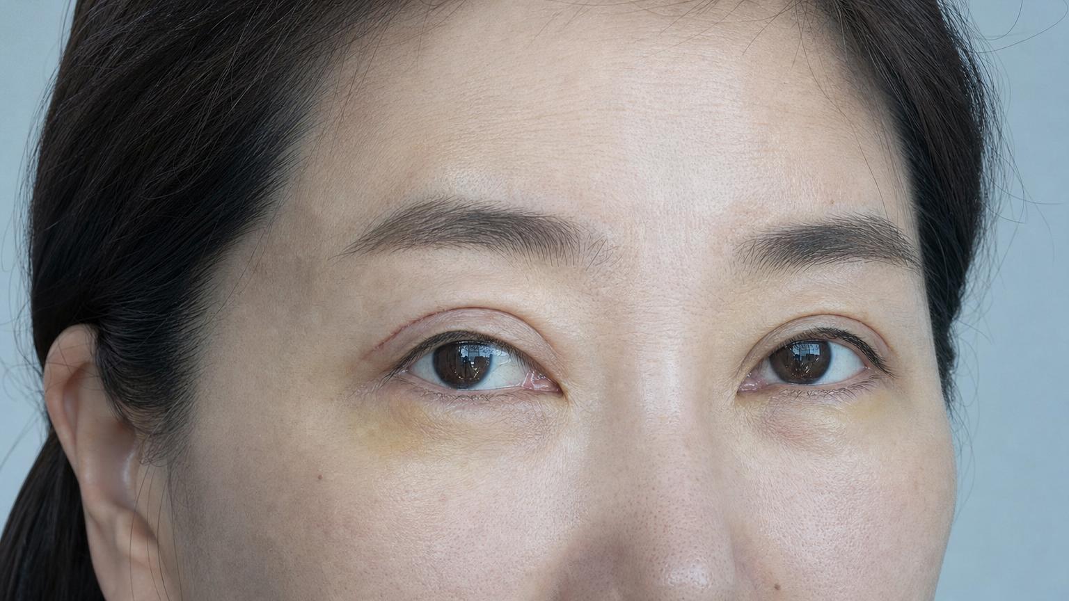 Post-operative day 7: upper lid sutures removed, mild residual swelling, faint yellow-green bruising resolving, eyes open and bright.