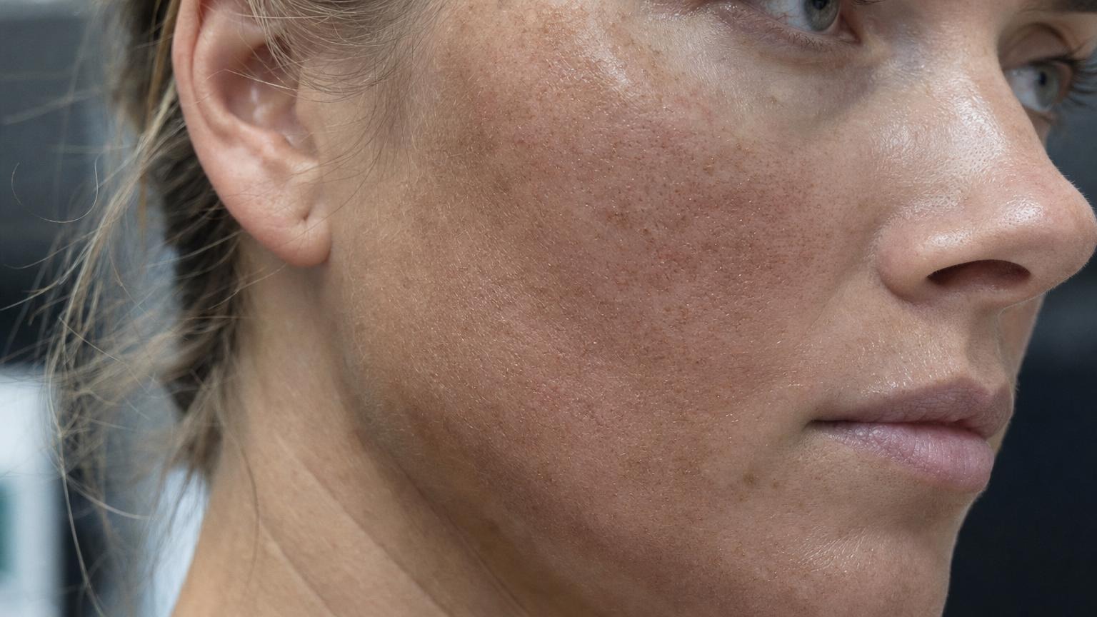 Day four after fractional laser: fine bronzed micro-crusting, mild residual pink and dry flaking